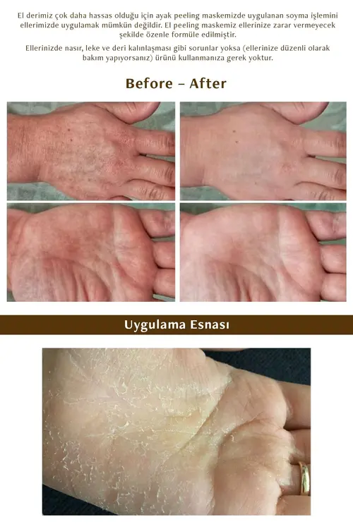 Mjcare Hand Peeling - Soyulan El Peeling Maskesi